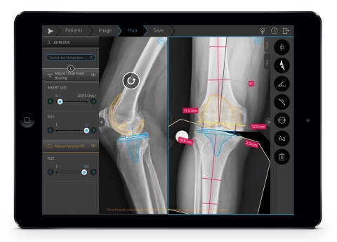 Brainlab Increases Automation in Orthopedic Digital Templating ...